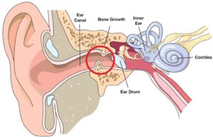 Picture of bone growth in ear